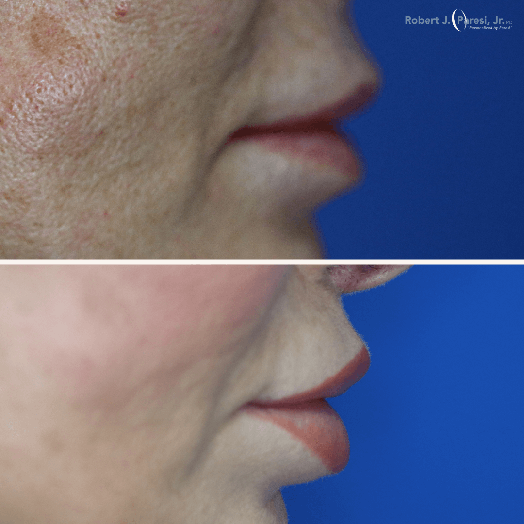 Lip Lift
